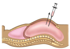 paracentesis(1)