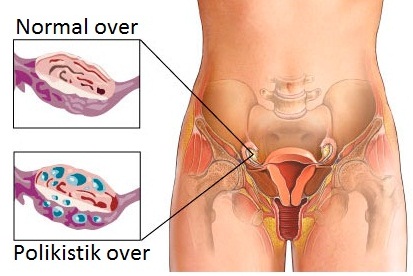 Polikistik Yumurtalık adet düzensizliği yaparmı