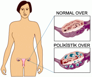 polycystic-ovary