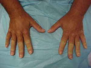 raynaud