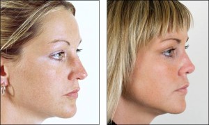 rhinoplasty_1027059028m