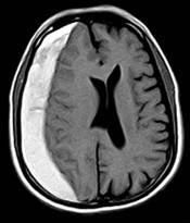 subdural