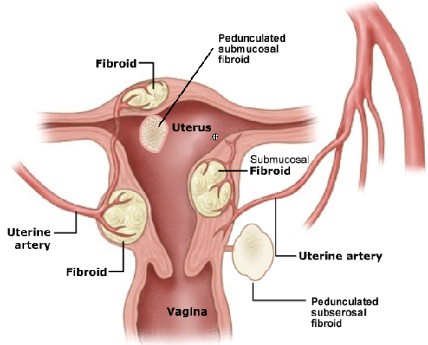 Uterin Polipleri veya Miyomları adet gecikmesi yaparmı